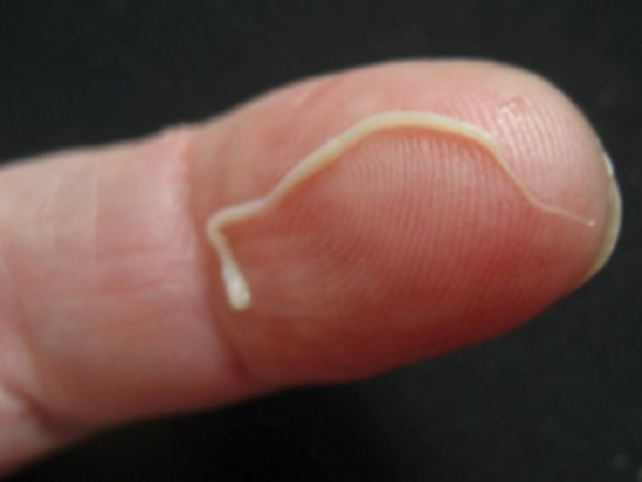 В Мелитополе хирурги удалили из руки пациента живого червя - второй случай с начала года (фото)