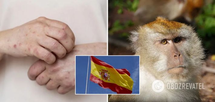 В Испании зафиксировали первую смерть человека от обезьяньей оспы – El Mundo