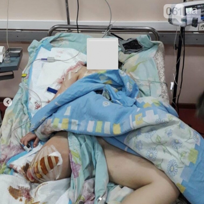 В больницу Запорожья доставили девочку, которой в результате обстрела оторвало ногу
