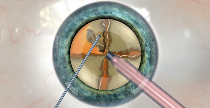 Что такое факоэмульсификация катаракты?