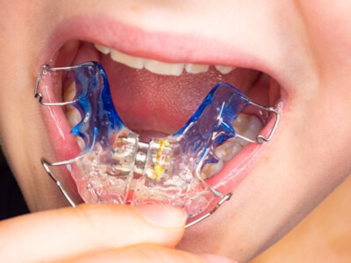 Какие виды ортодонтических брекетов существуют?