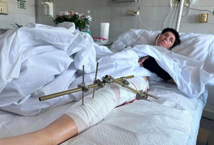 Запорізькі лікарі повідомили про стан журналістки Ольги Звонарьової, яка постраждала від обстрілів рф