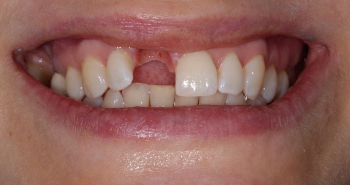 Видалили не той зуб: у Мелітополі горе-стоматолог вирвав дитині корінний зуб